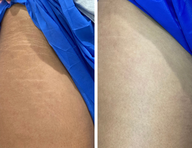 Before and after treatment example showing the appearance of body stretch marks