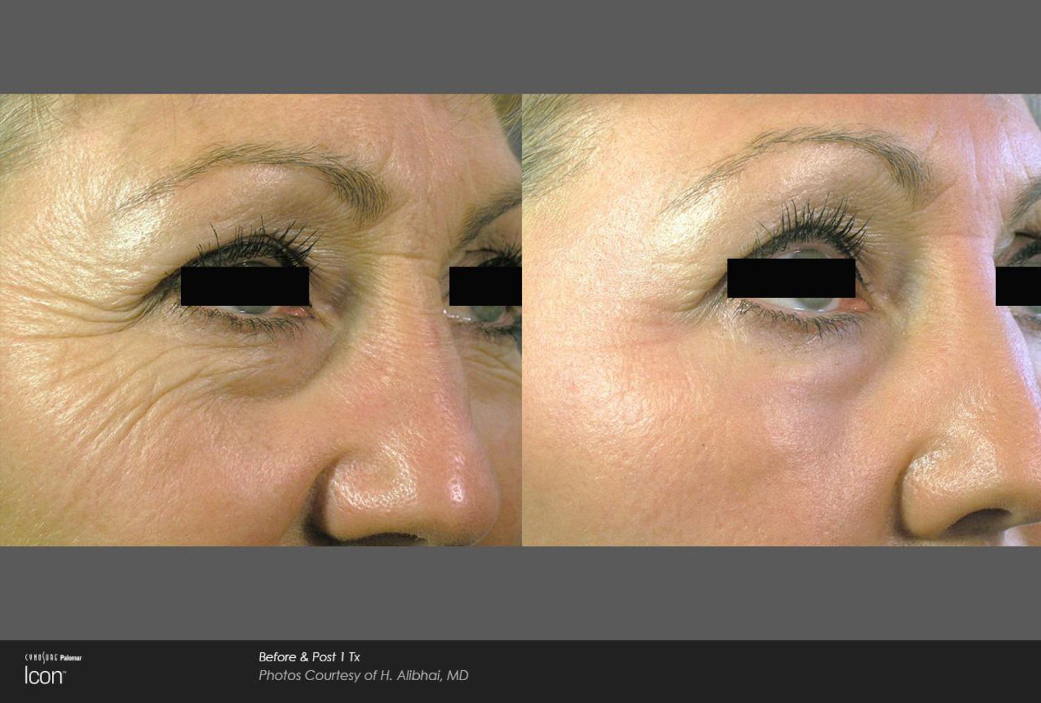 Before and after clinical example showing improvement in fine lines around the eyes