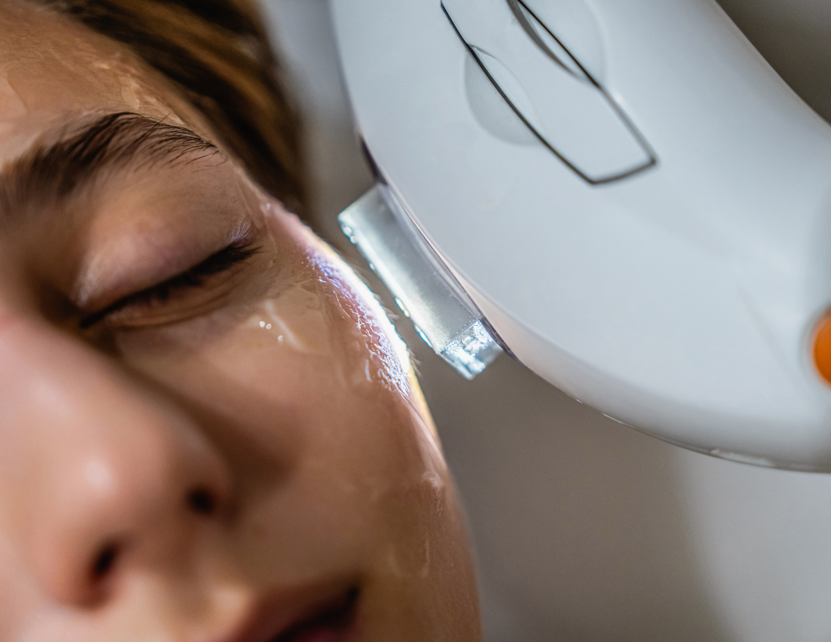 IPL photofacial treatment being performed at Dash Medical Spa and Laser