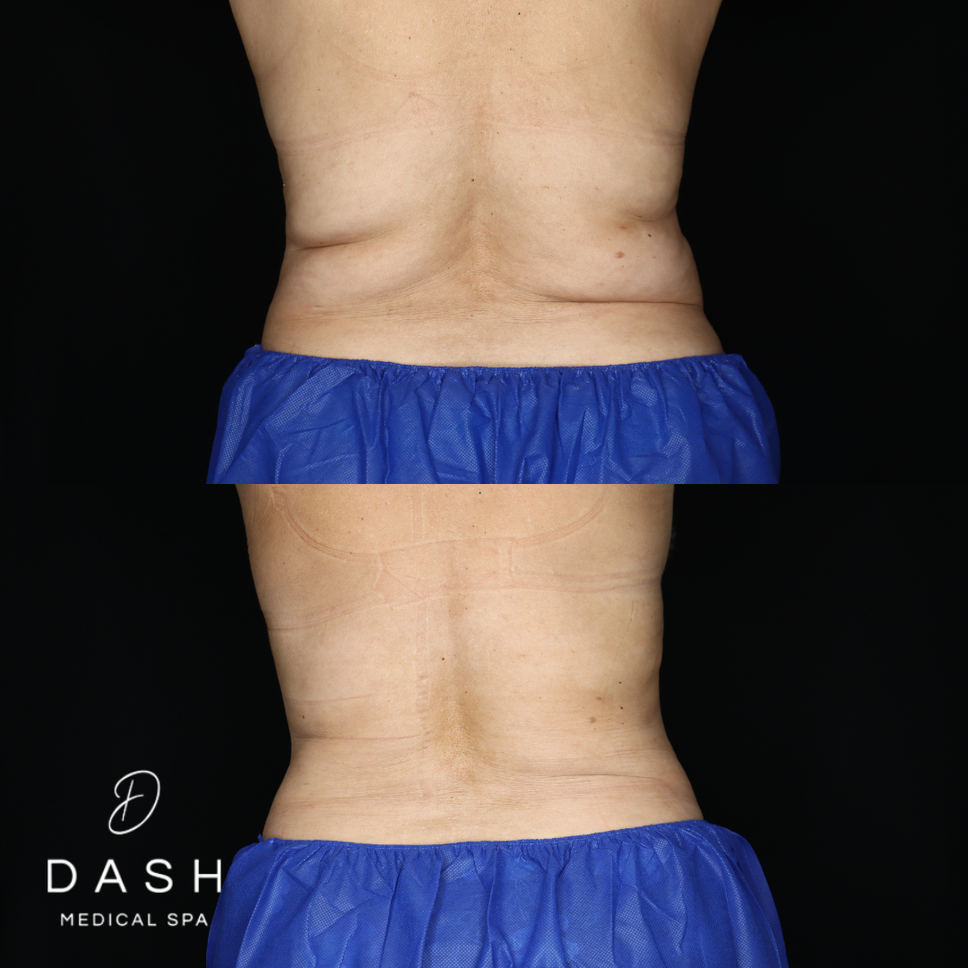 Actual Dash Medical Spa client before and after CoolSculpting treatment of the waist and flanks
