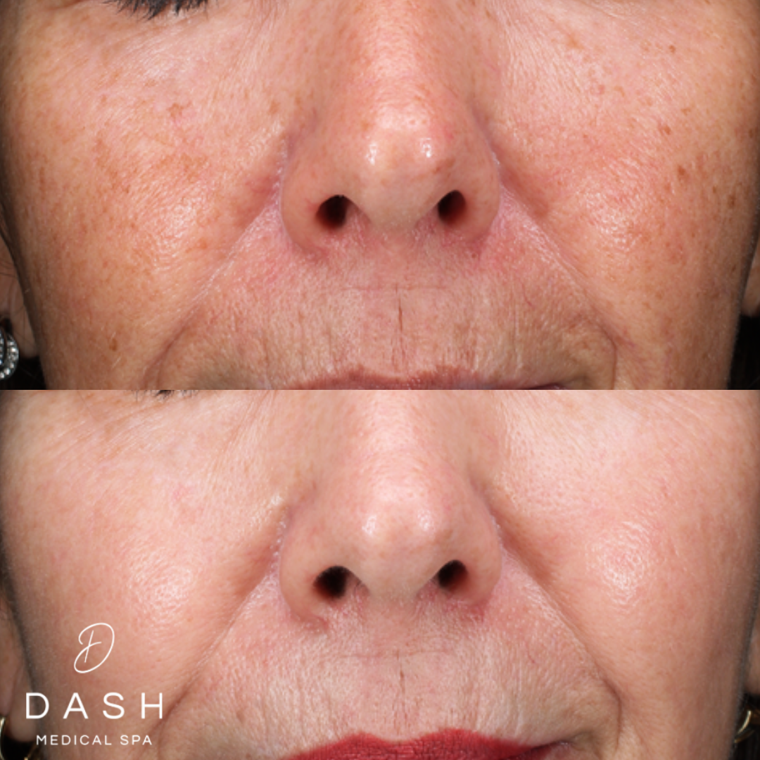 Before and after IPL result for facial pigment at Dash Medical Spa
