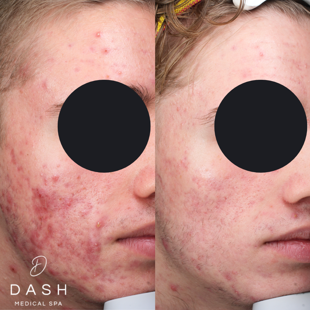 Dash Medical Spa client before and after acne treatment showing visible improvement in active breakouts
