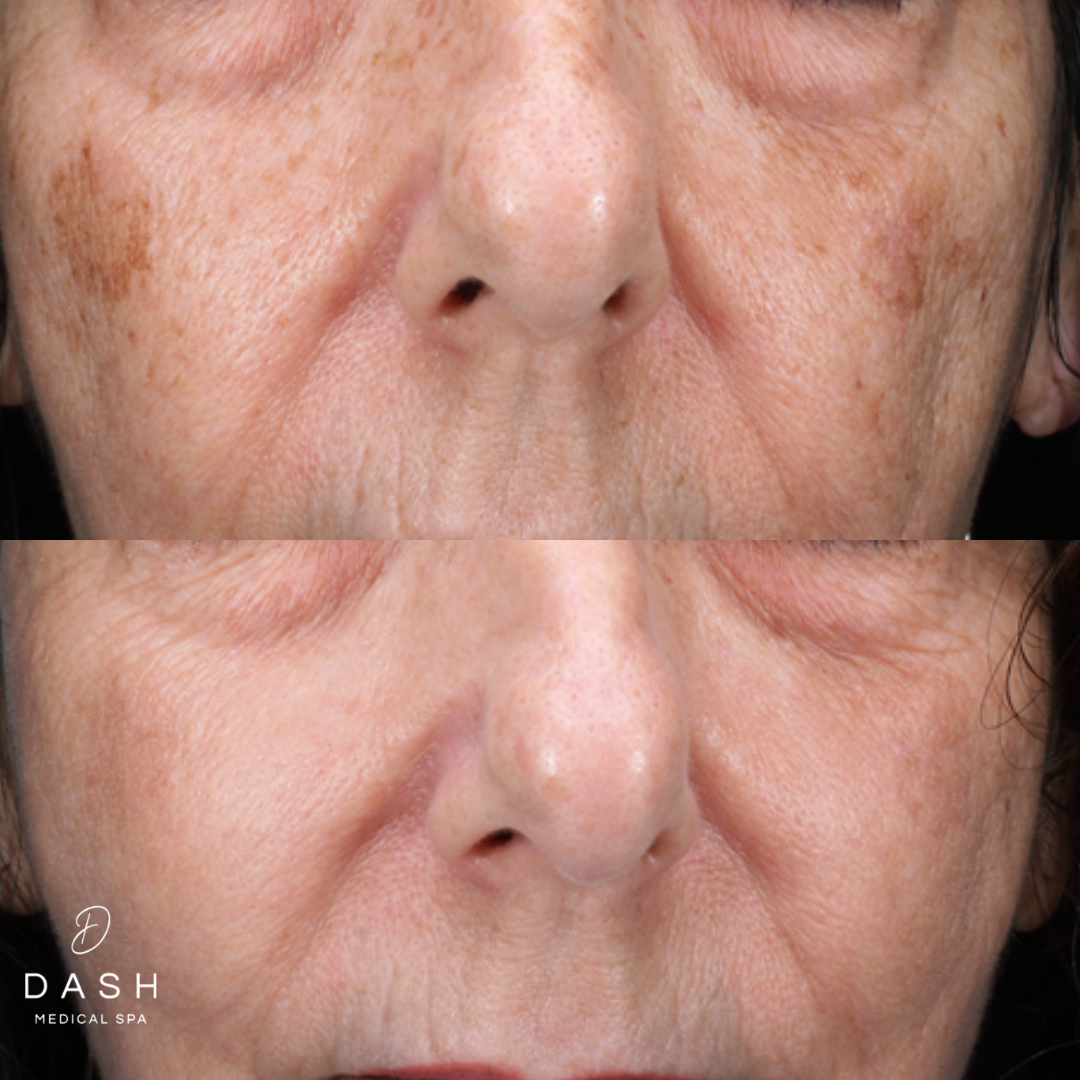 Dash Medical Spa IPL before and after example for sun-related discoloration