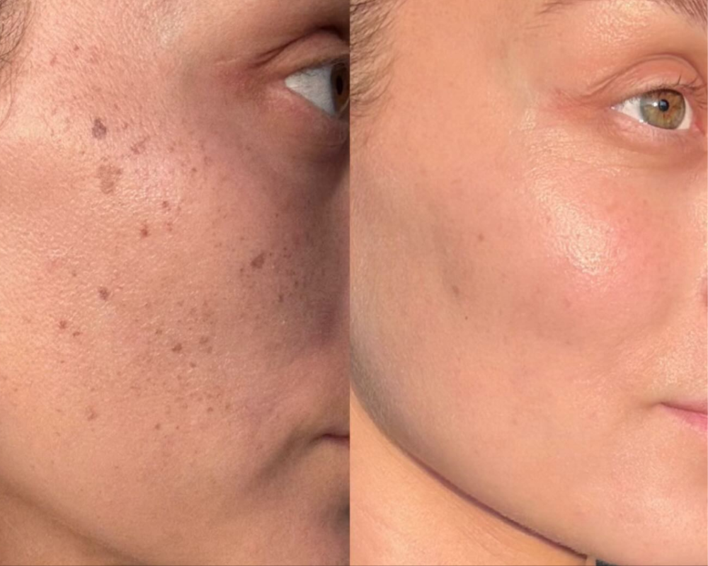 IPL before and after result showing improvement in brown spots and uneven pigmentation
