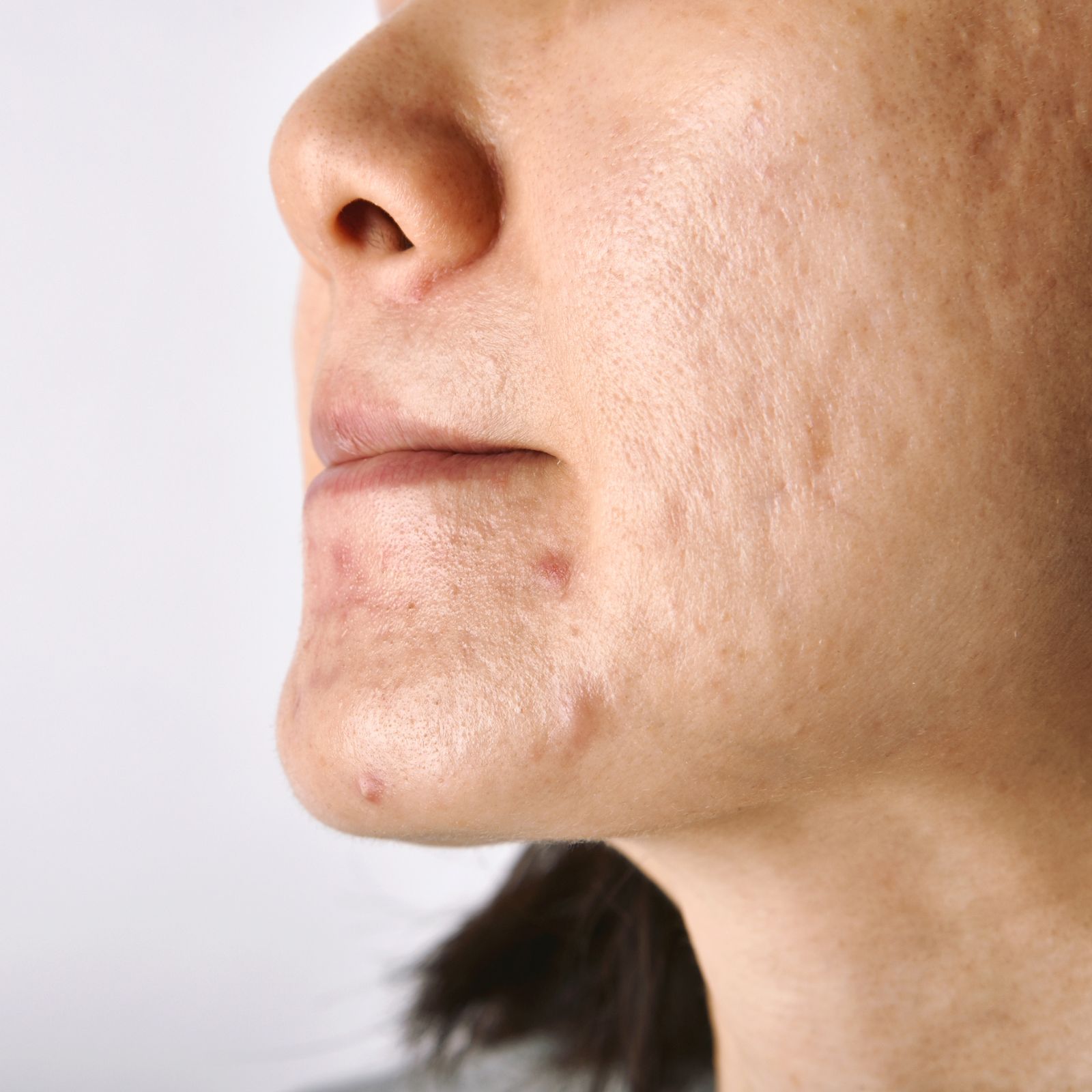 Close-up showing uneven skin texture and acne scarring on the cheek and jawline