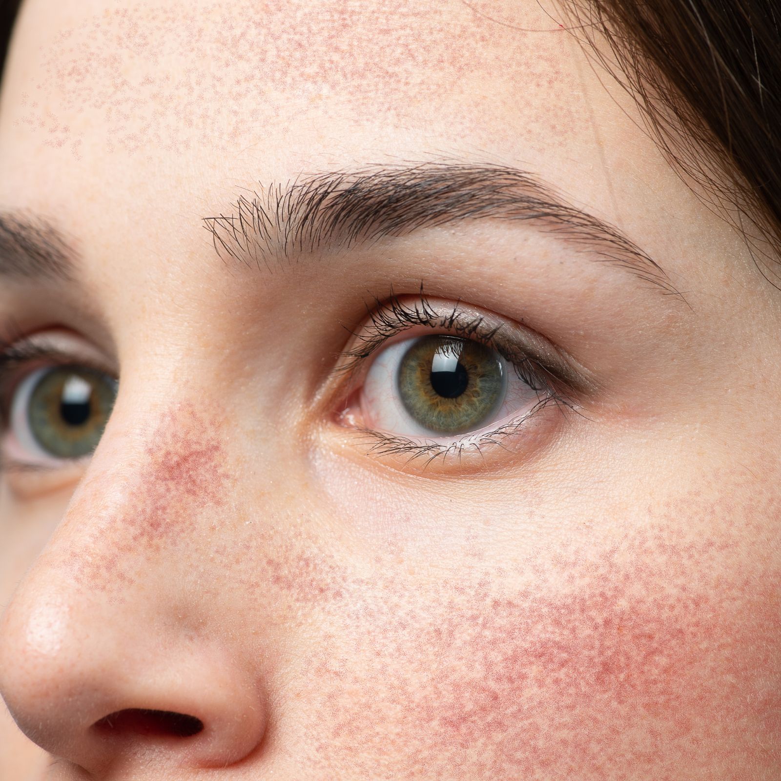 Close-up of persistent facial redness across the cheeks and nose