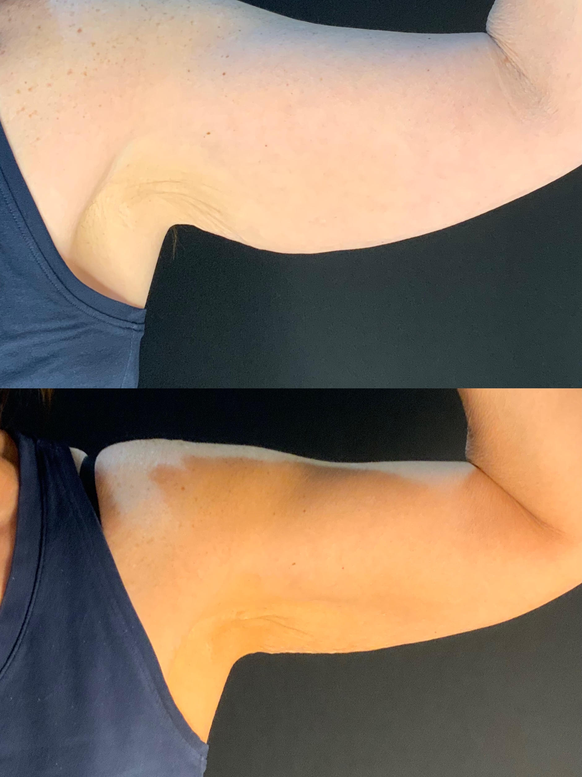 CoolSculpting before and after result for the upper arm
