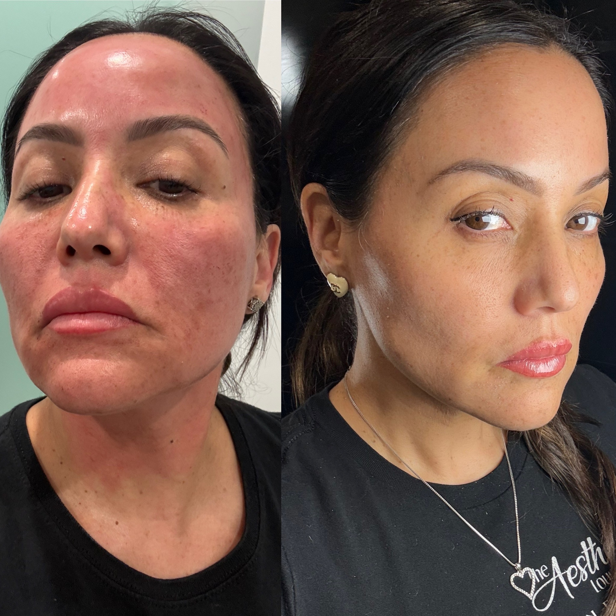 SkinPen before and after
