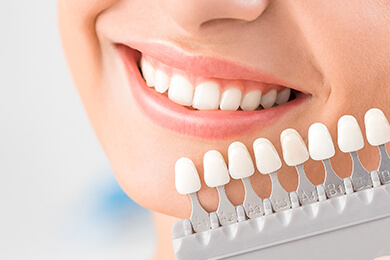 Dental Veneers