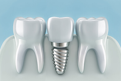 Dental Implants