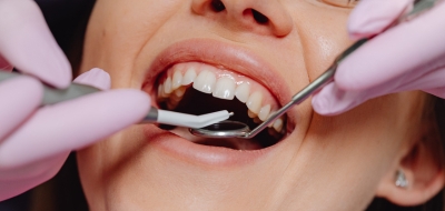 Limpieza dental