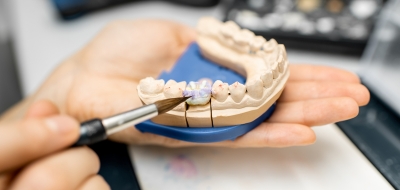 Prótesis dentales