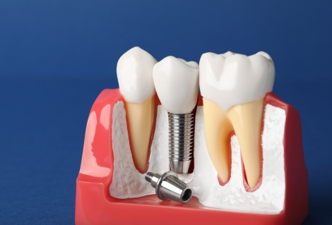 Implanturi Dentare In Oradea