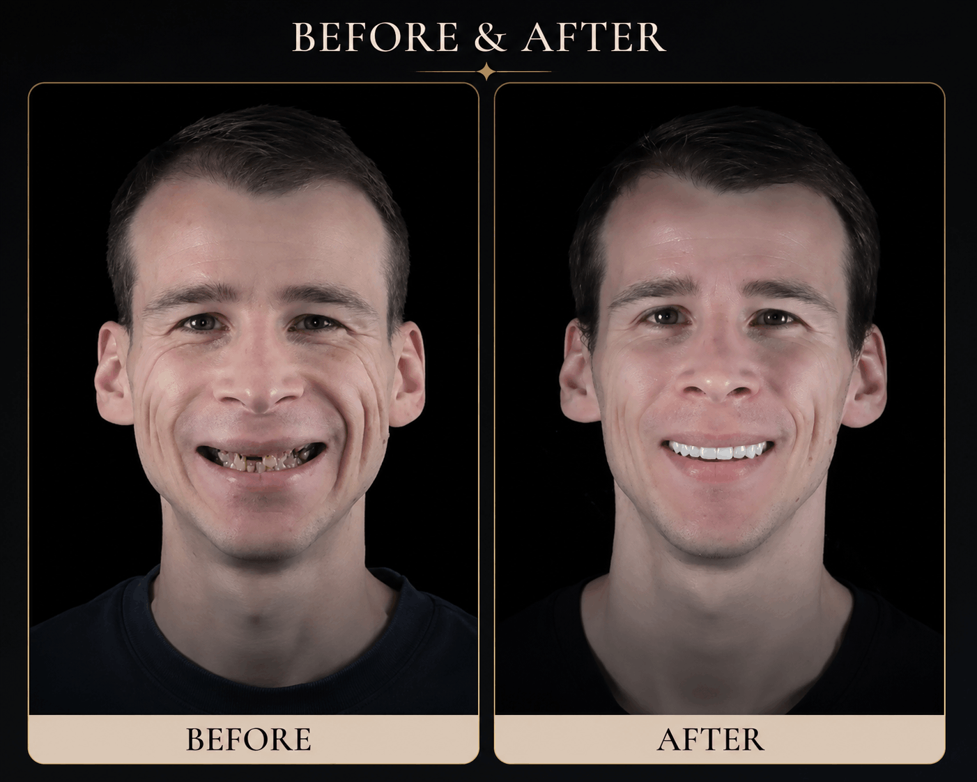 Dental implant transformation - Dental Atelier patient 3