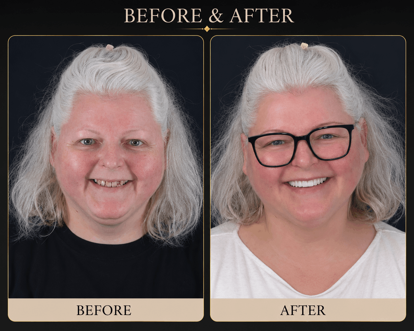 Dental implant transformation - Dental Atelier patient 2