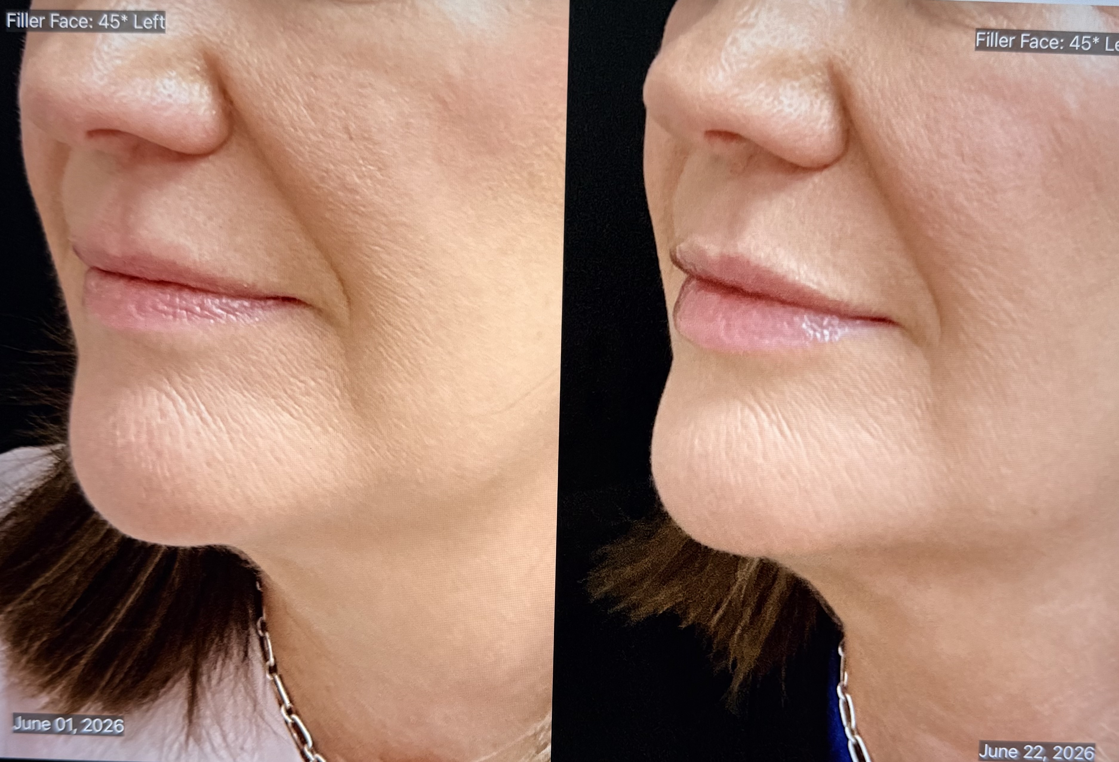 Dermal Fillers Before & After