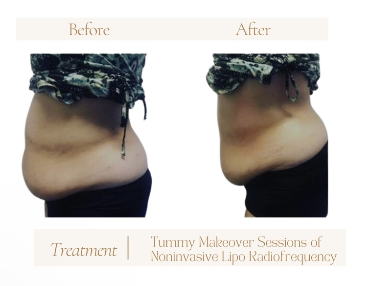 flat tummy BodyLift Houston noninvasive lipo viora