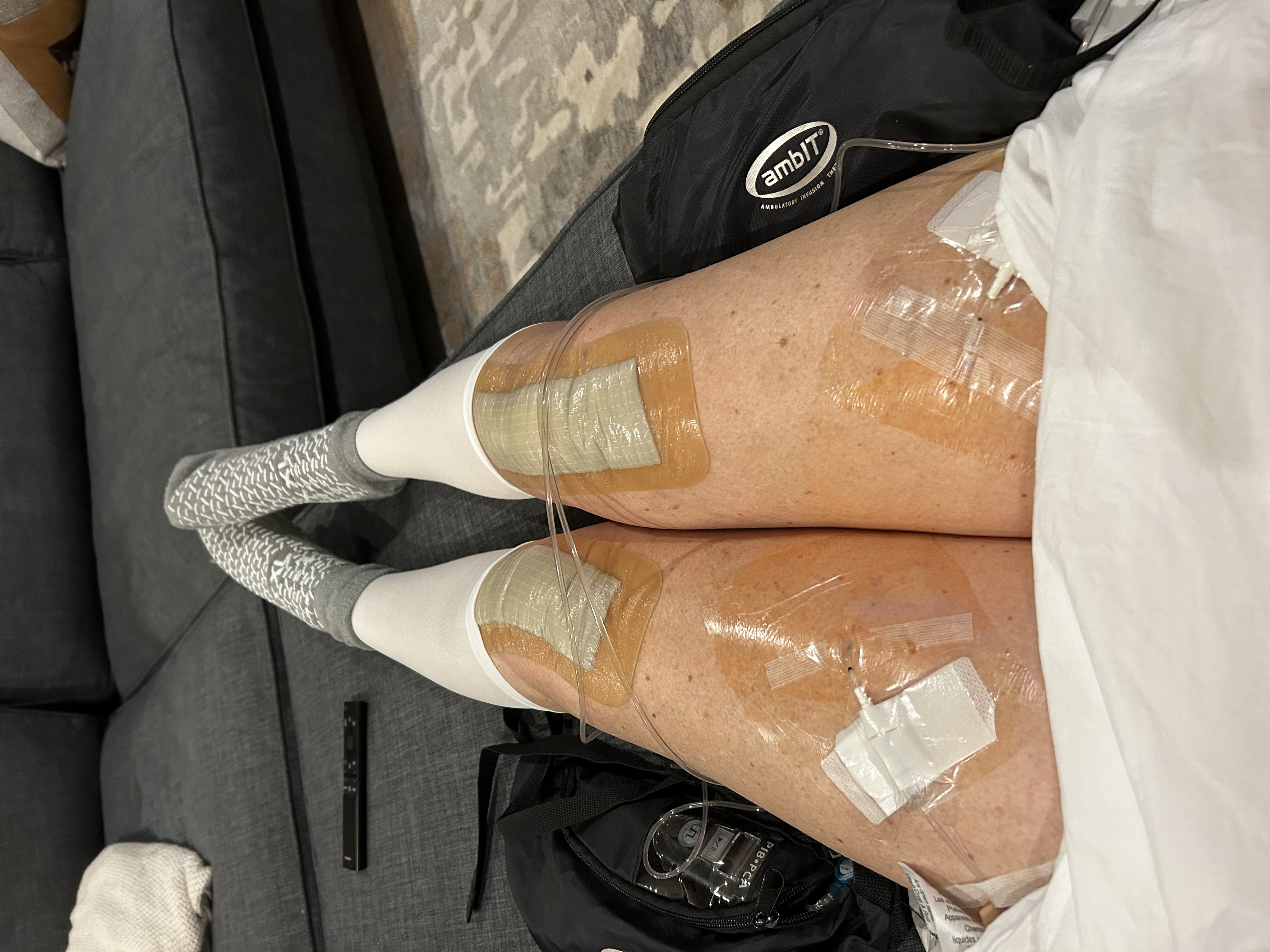 Diana walking up stairs after knee replacement