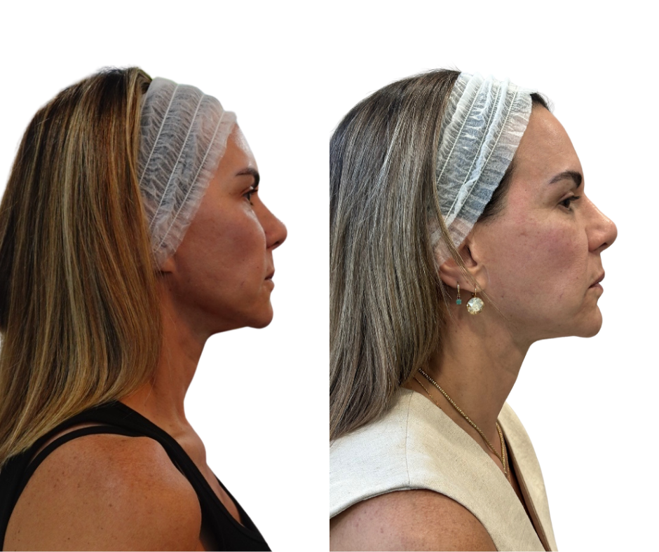 Experience cutting-edge Fotona laser treatments in Miami and Doral