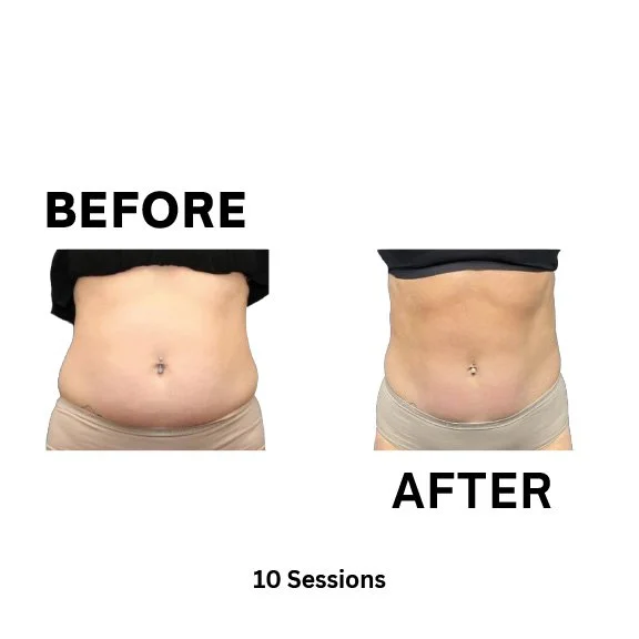 Glypto Before and After