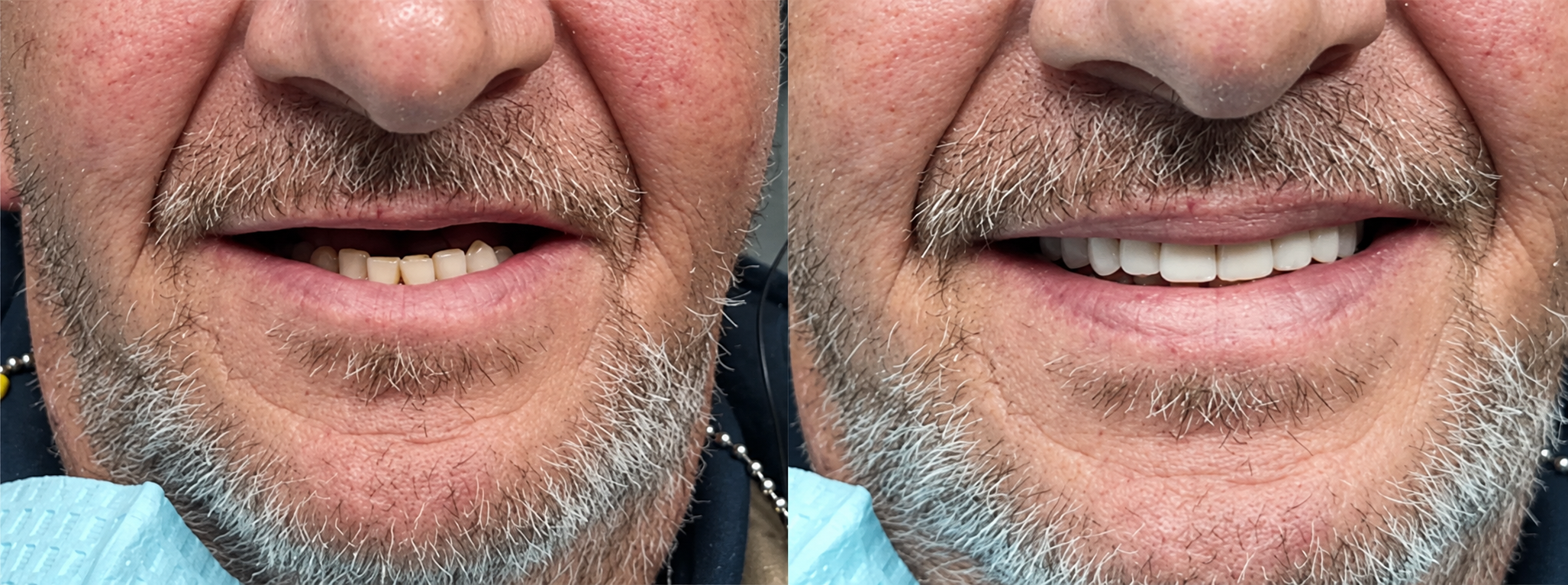 Patient smile before and after full mouth dental implant treatment