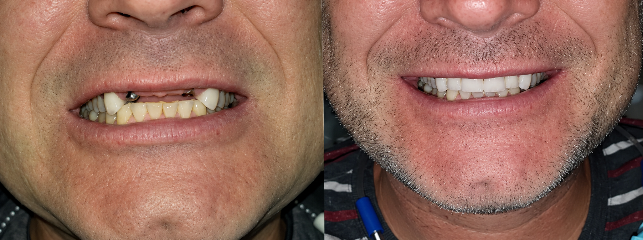 Patient smile before and after full mouth dental implant treatment