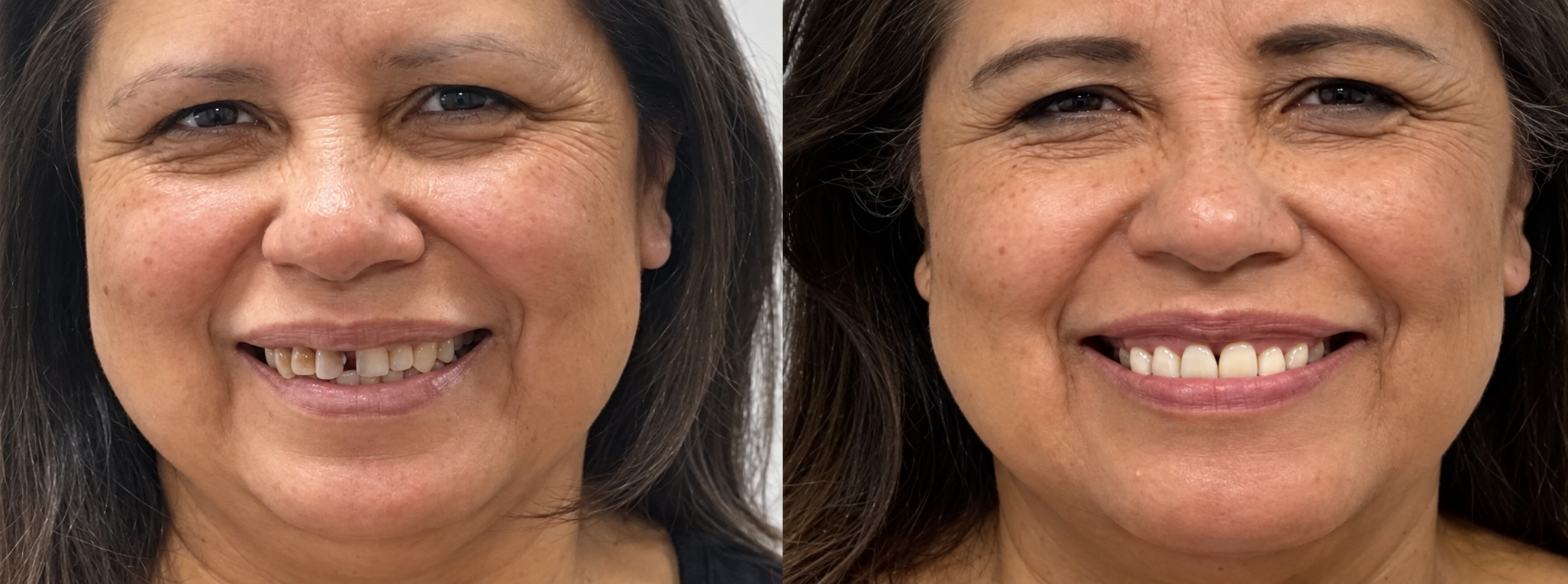 Patient smile before and after full mouth dental implant treatment
