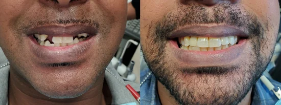 Patient smile before and after full mouth dental implant treatment