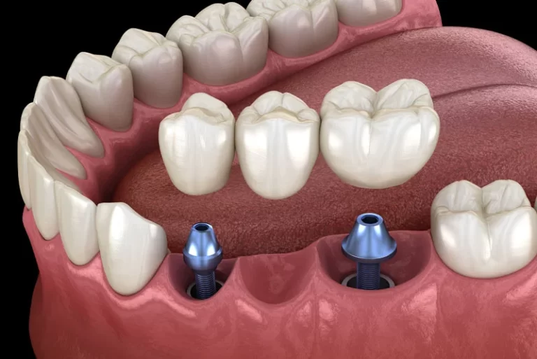 Implant Supported Bridge