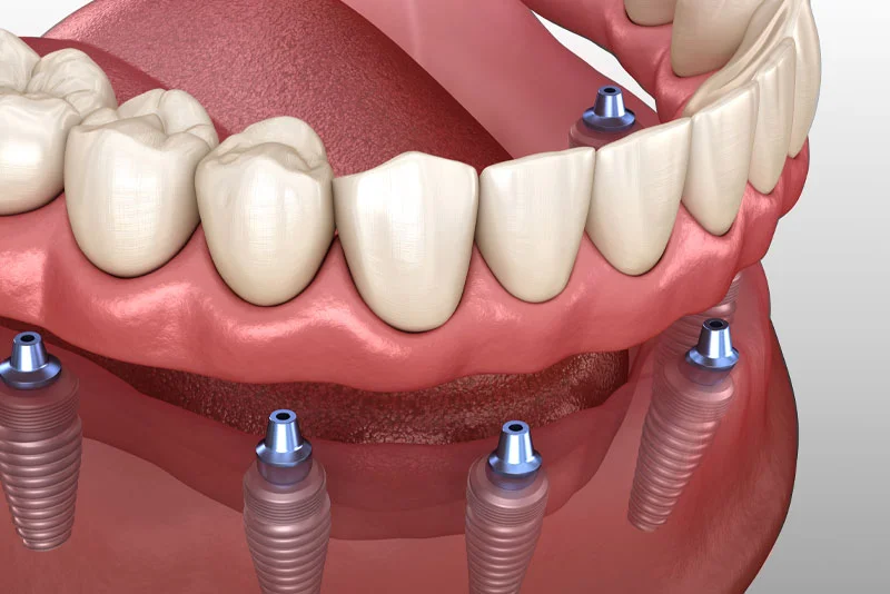 Implant Supported Dentures