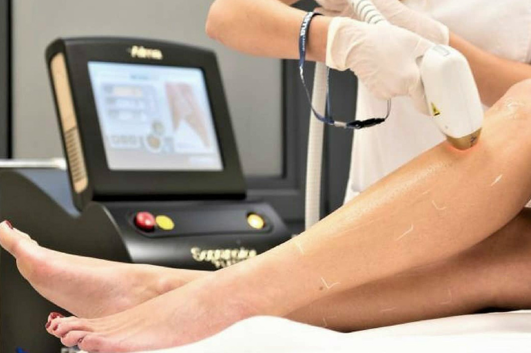 Laser hair removal treatment