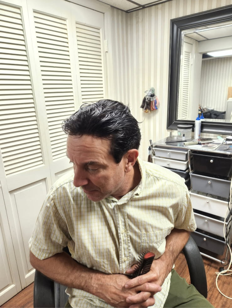 After hair replacement, side view