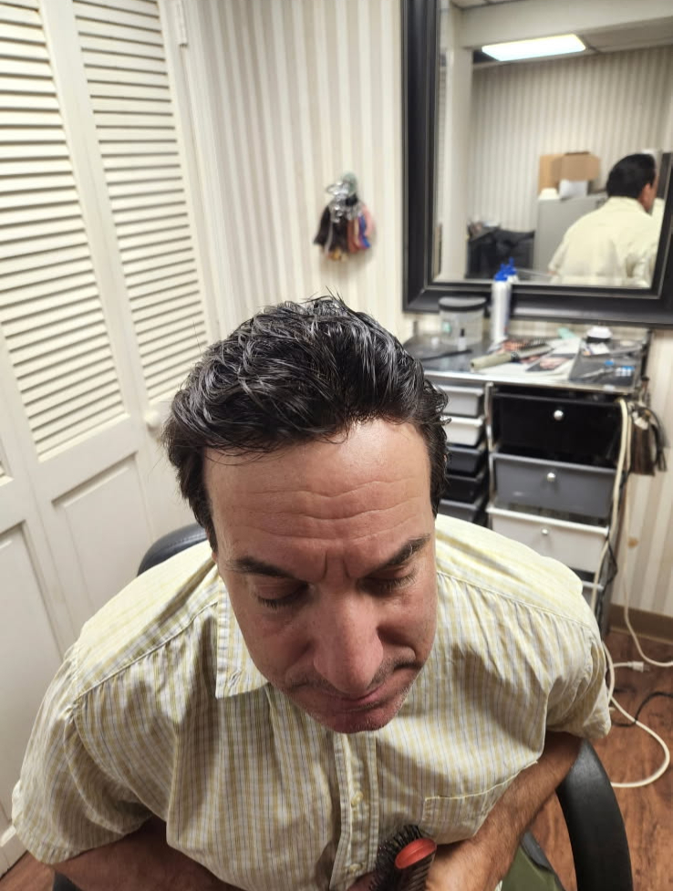 After hair replacement, front view