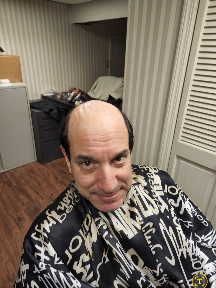 Before hair replacement, front view showing thinning around the crown