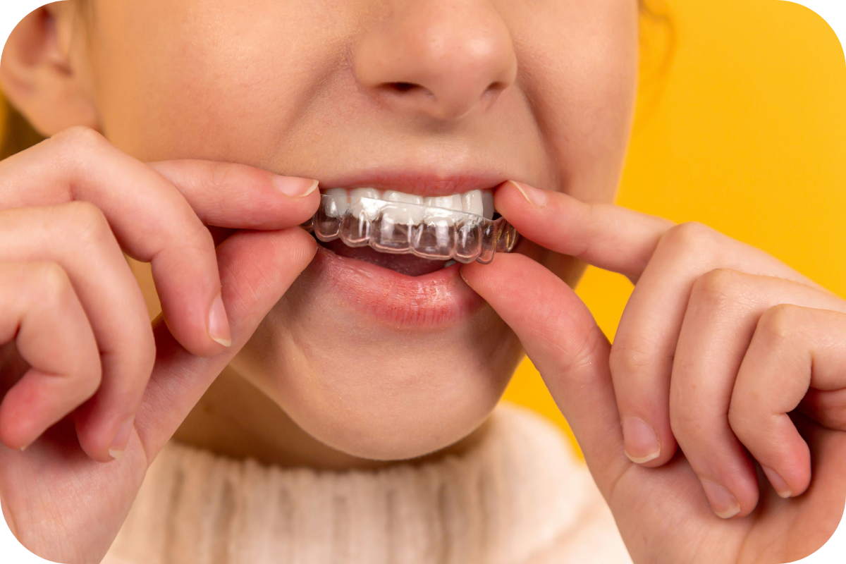 Clear, near-invisible dental aligner