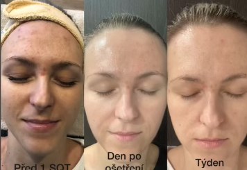 Klientka pred prvým SQT, deň po ošetrení a týždeň po