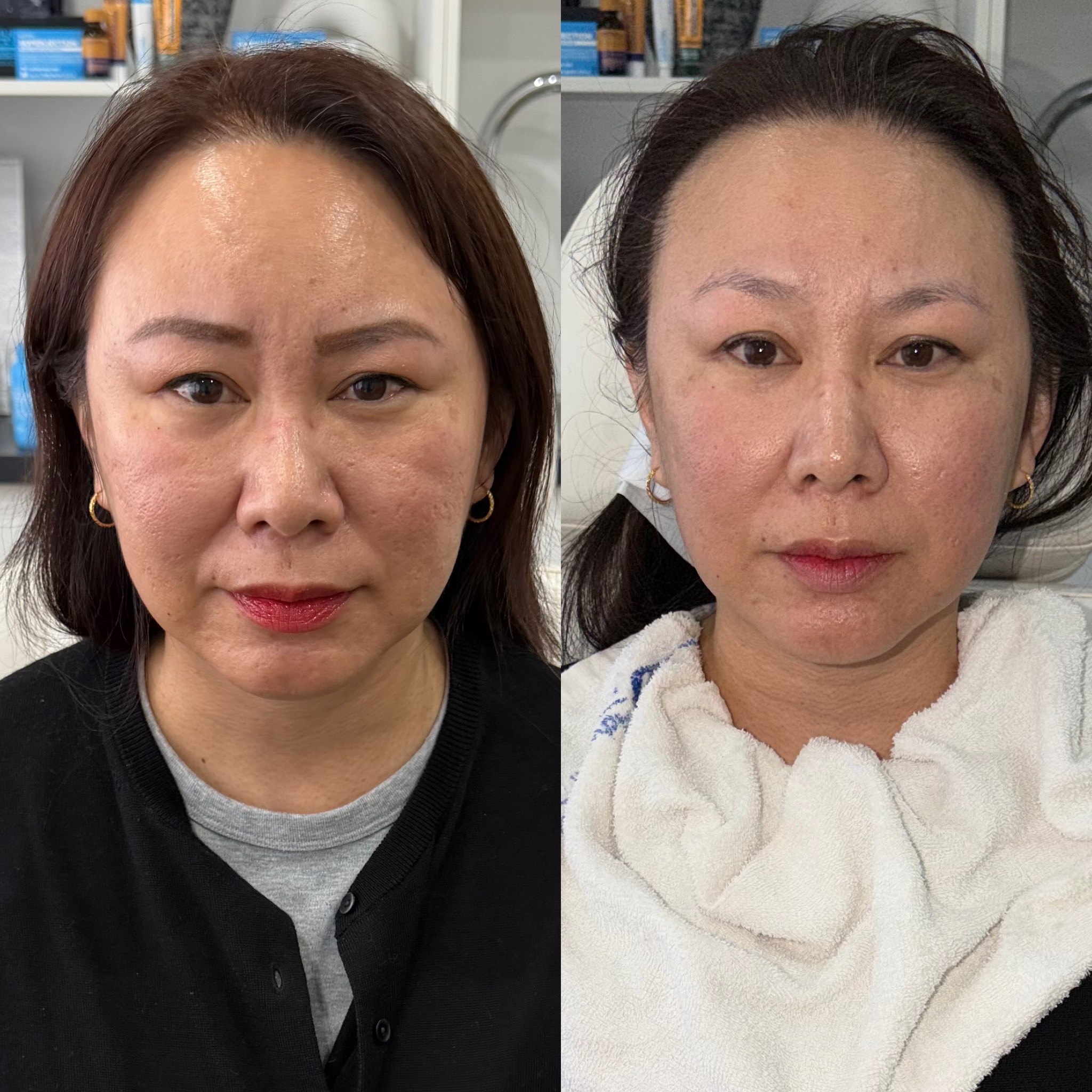 HIFU before and after — client result