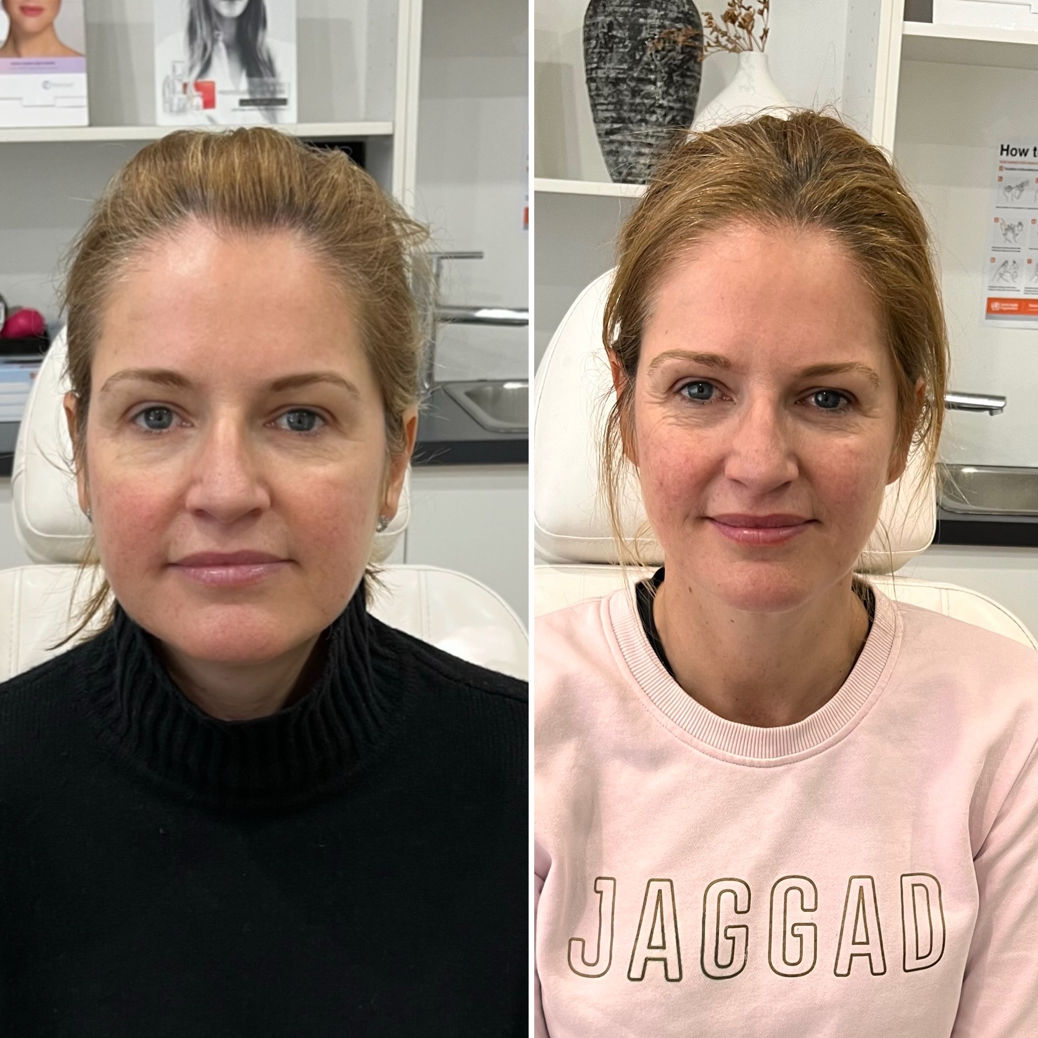 HIFU treatment moment