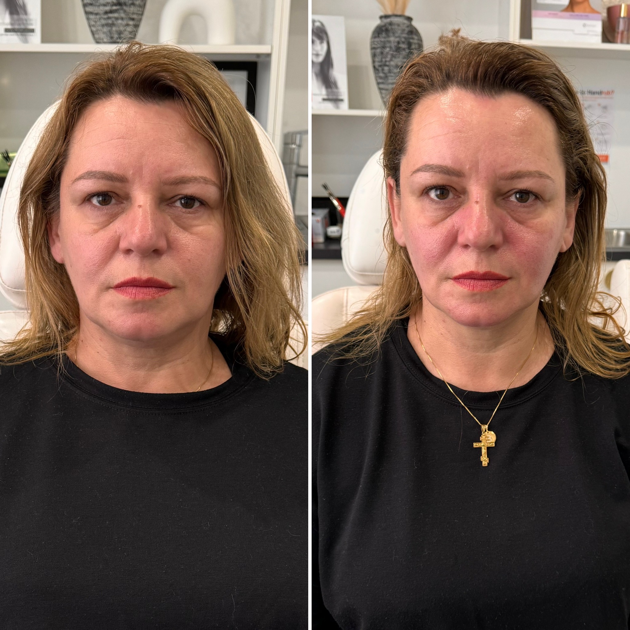 HIFU before and after — client result