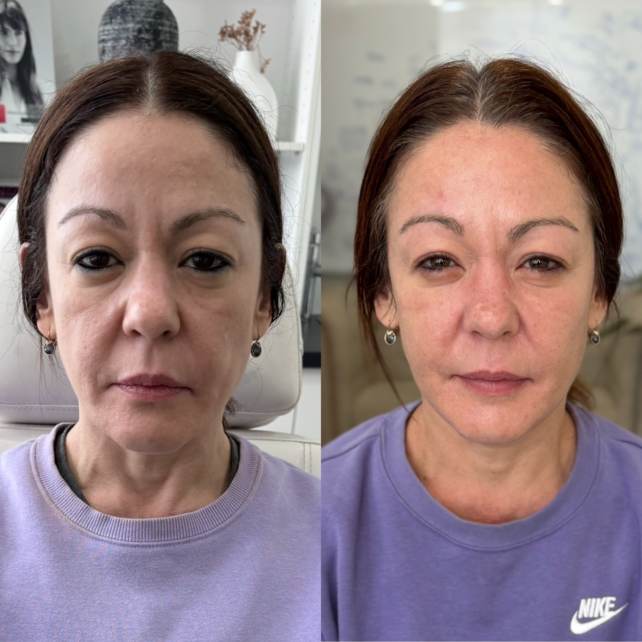 HIFU before and after — client result