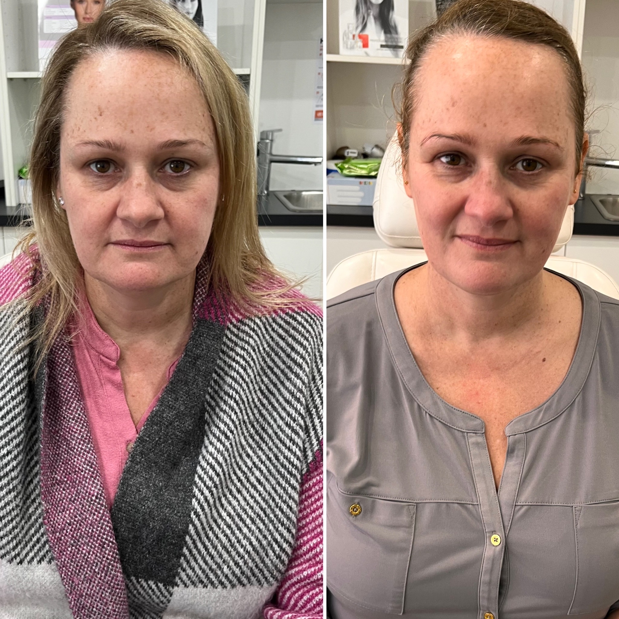 HIFU before and after — client result