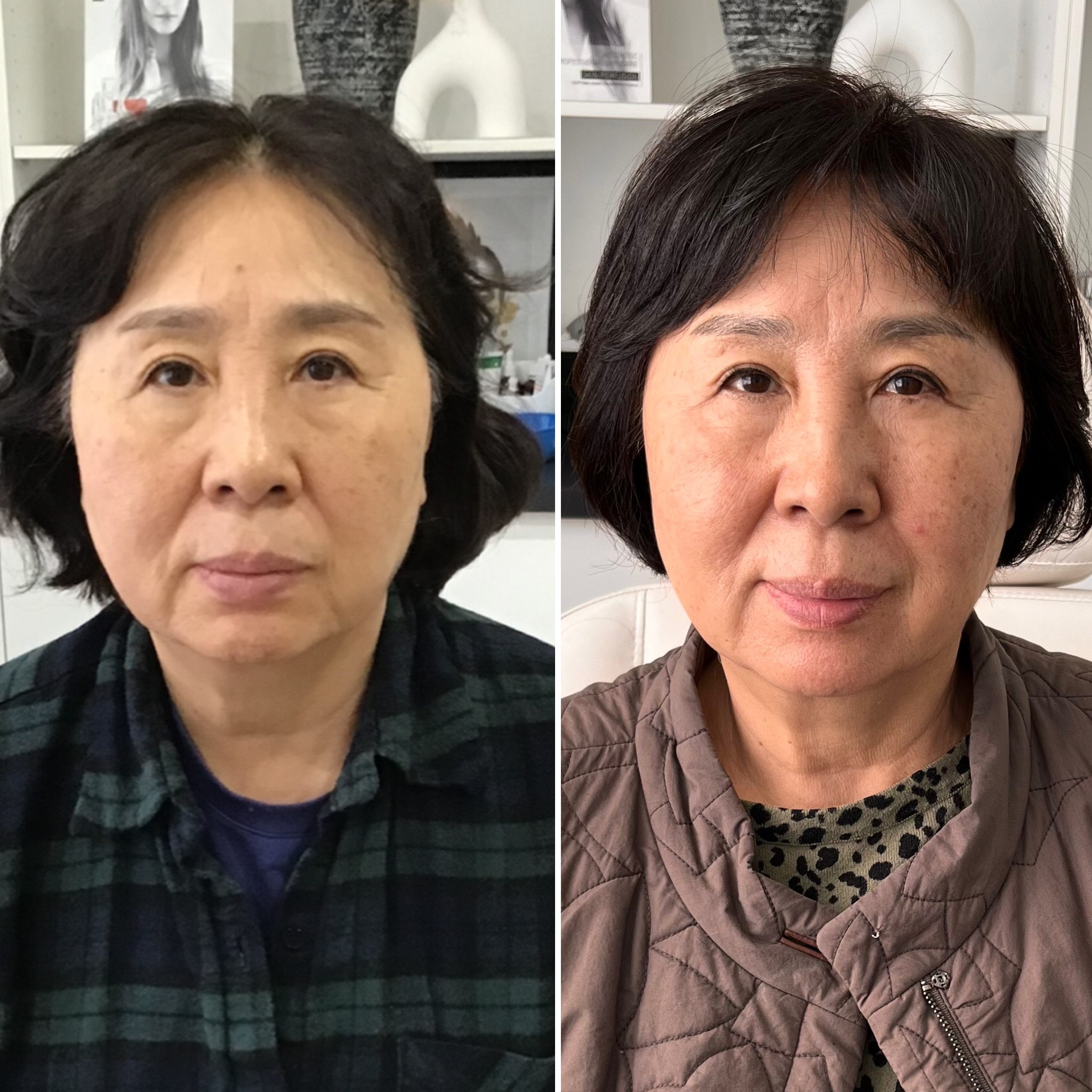 HIFU before and after — client result