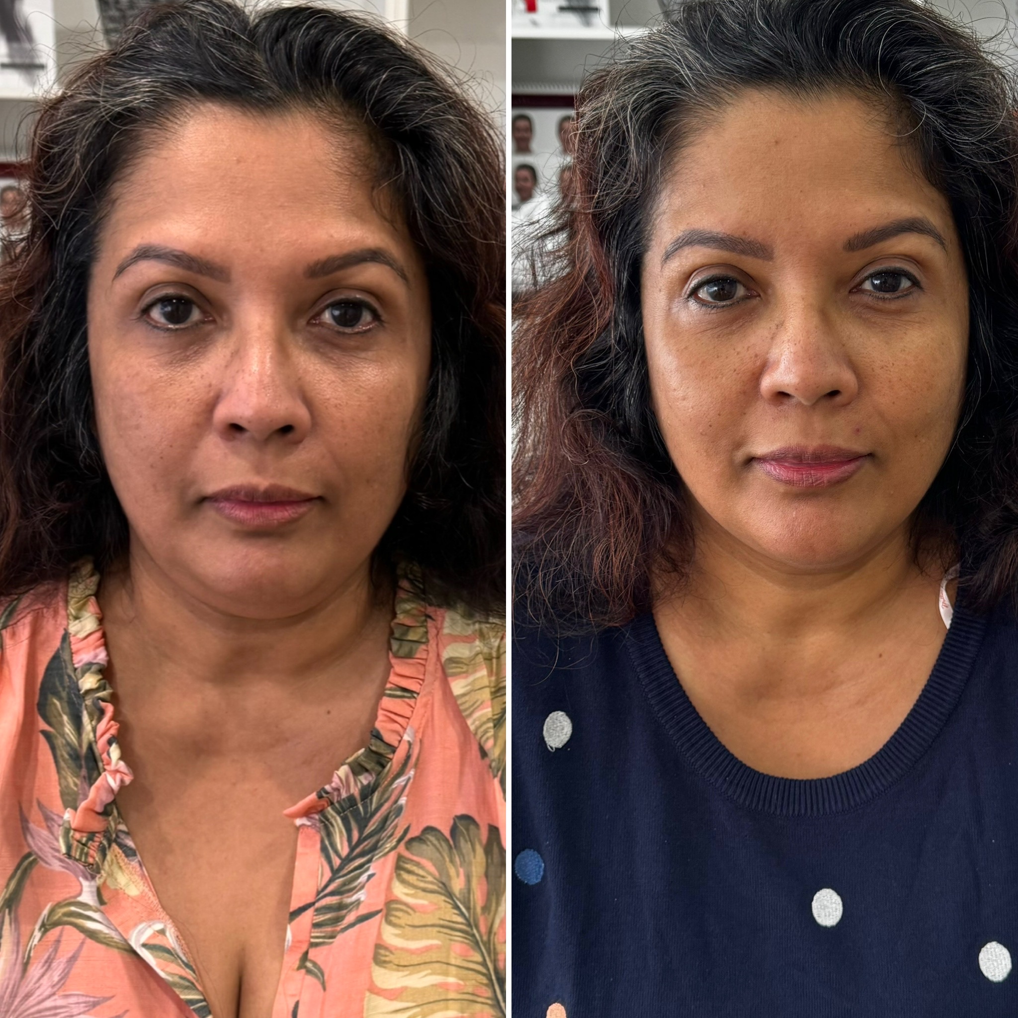 HIFU before and after — client result