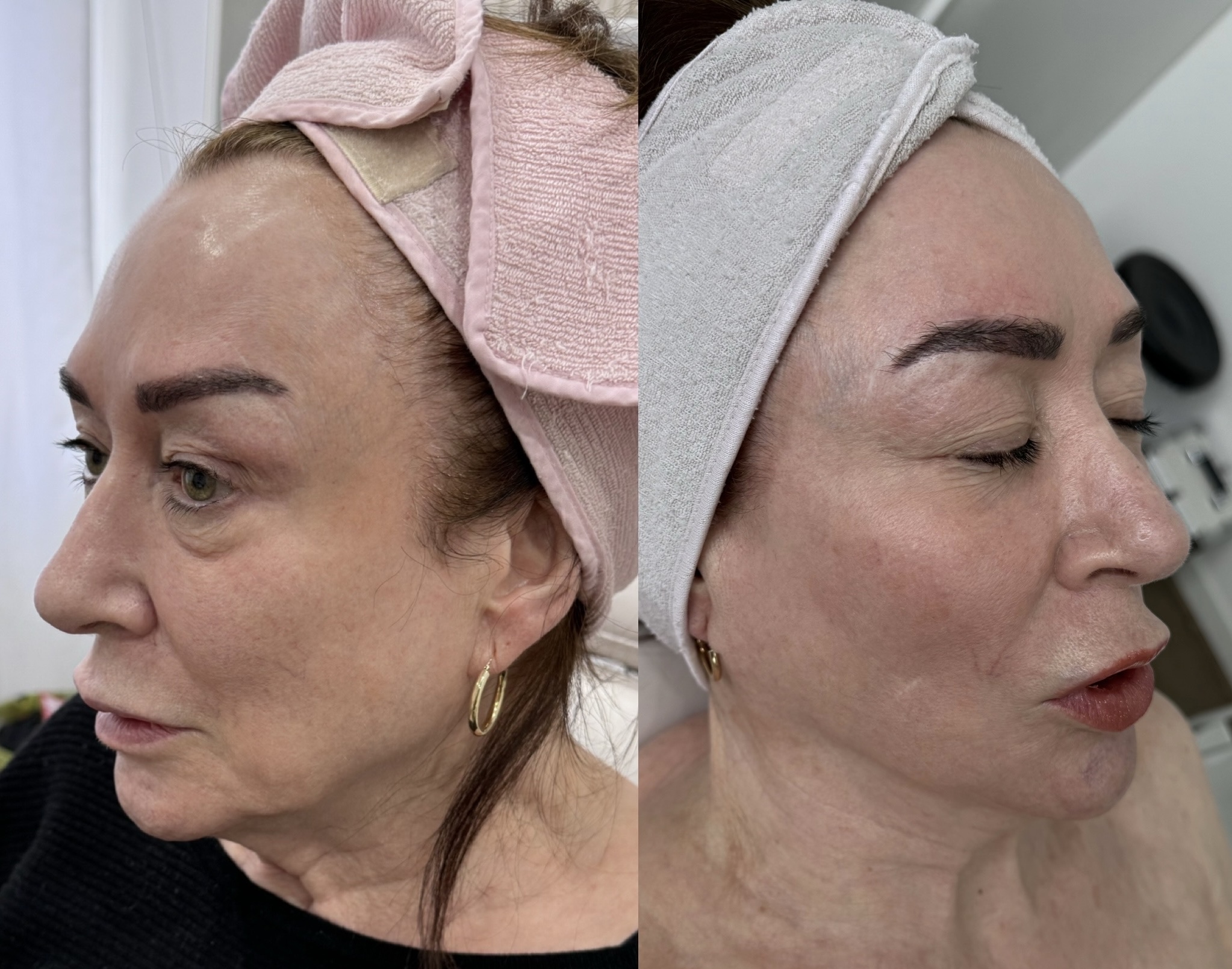 HIFU before and after — client result