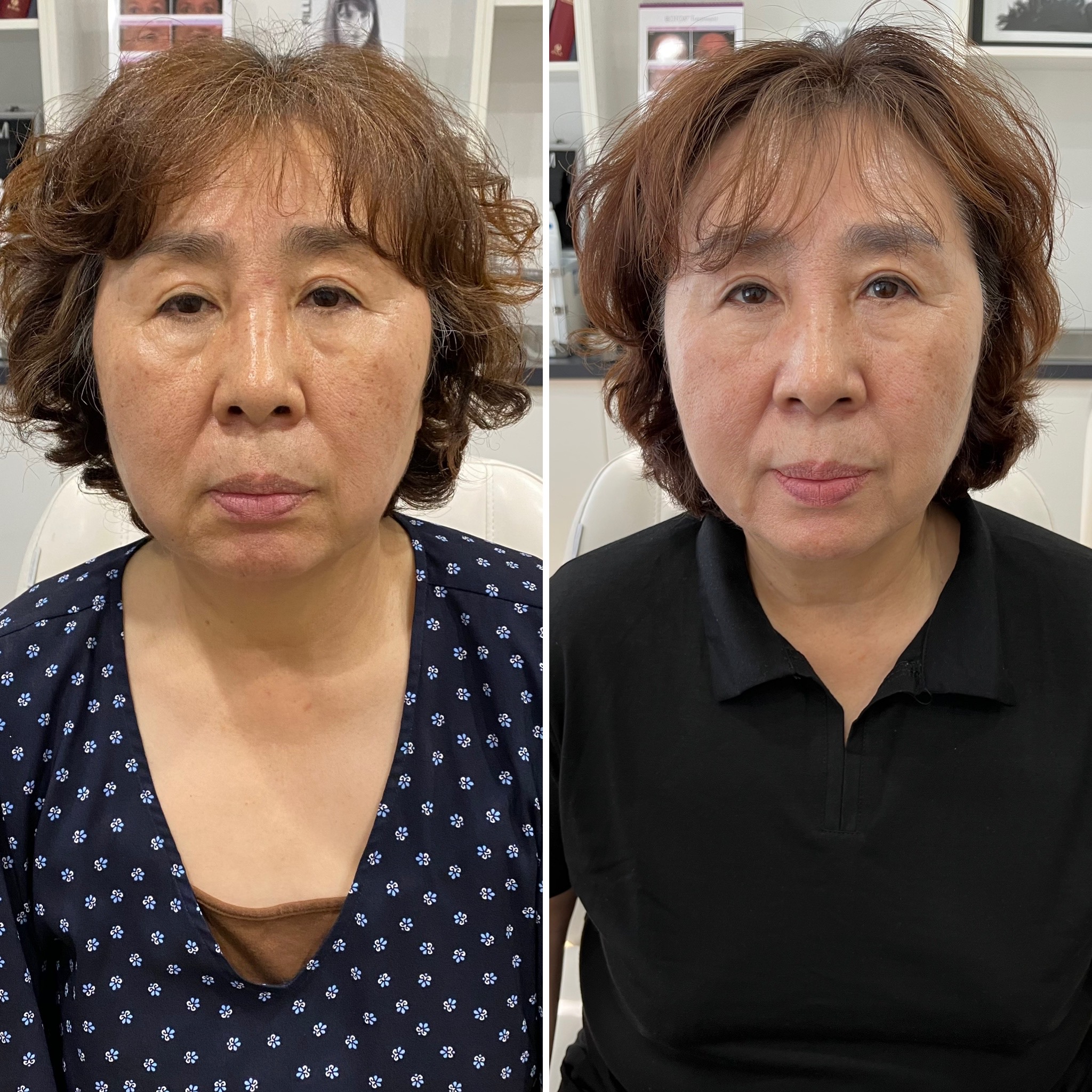 HIFU before and after — client result