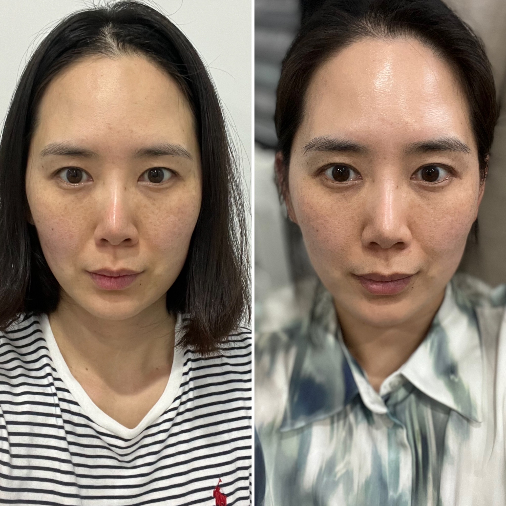 HIFU before and after — client result