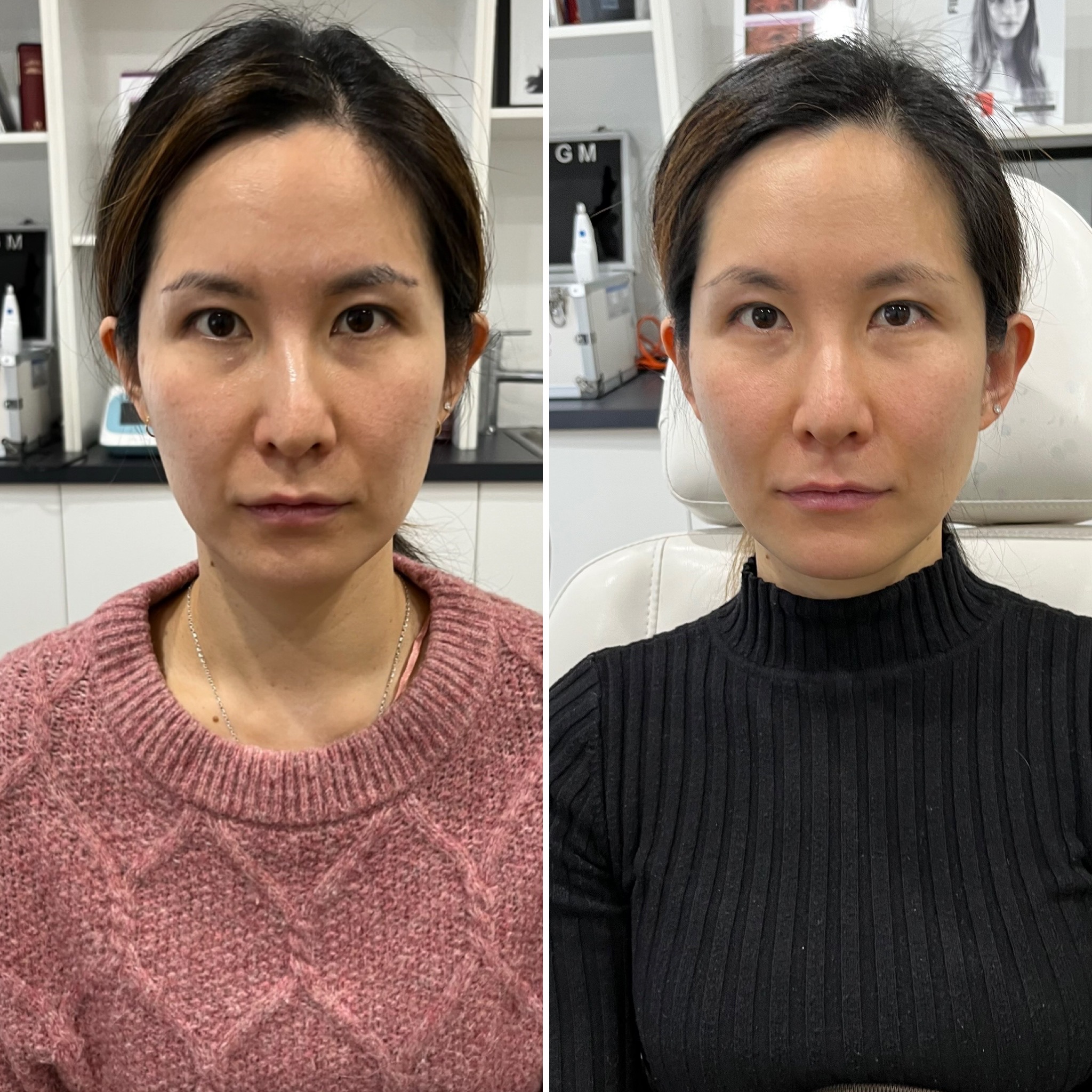 HIFU before and after — client result