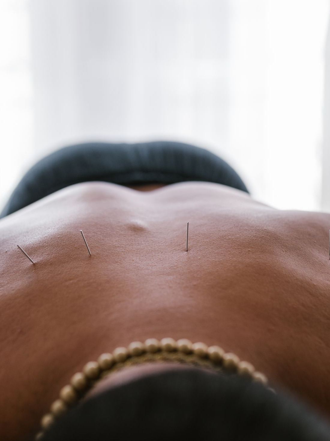 Dry needling trigger point release at Elevate Therapy Doral