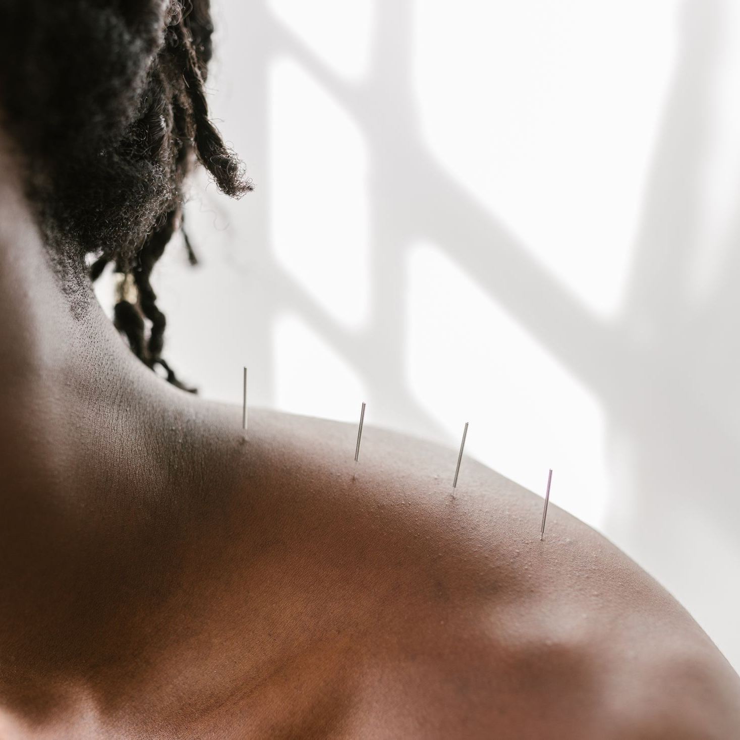 Dry needling — trigger point release