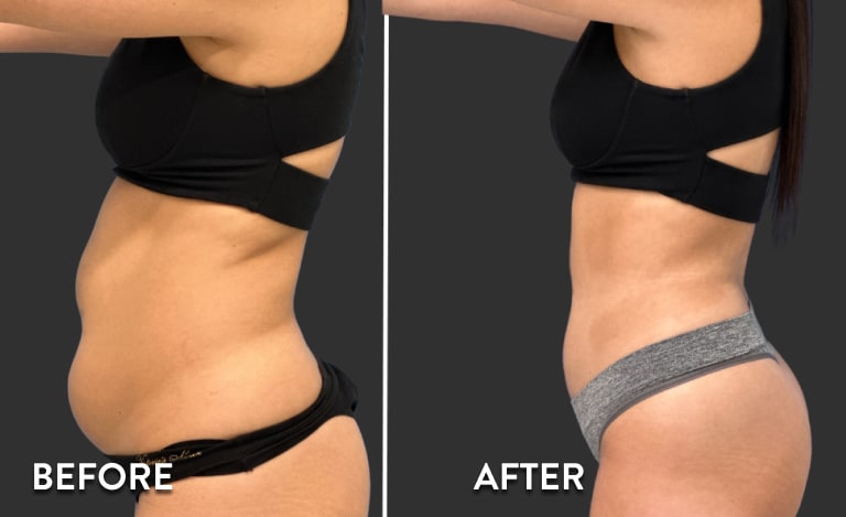 Before and after — Tummy Rescue transformation, SageWood Institute client